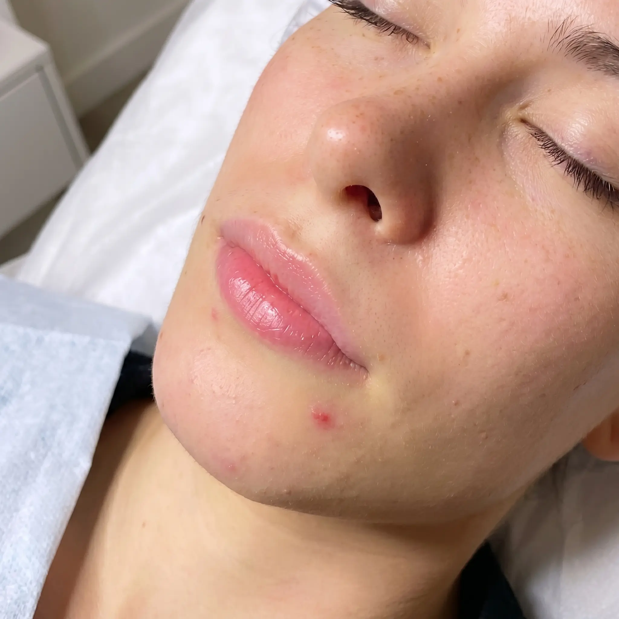 До процедуры — контурная пластика губ